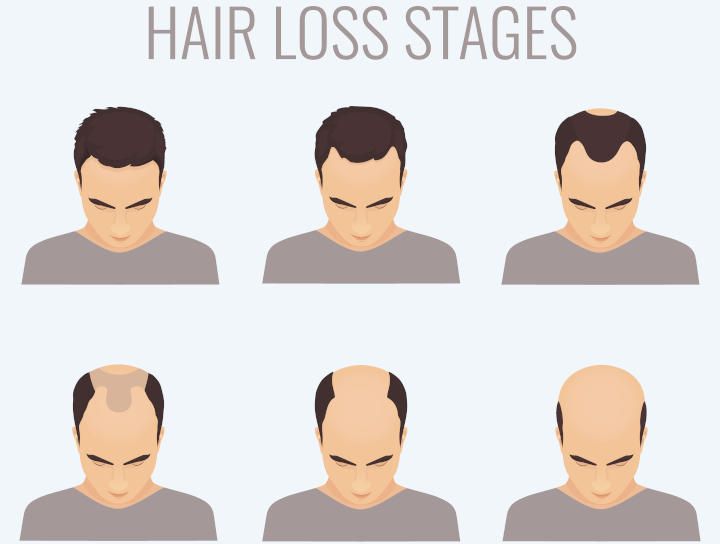 Understanding male hair loss & the best treatments available – The Players  Lounge